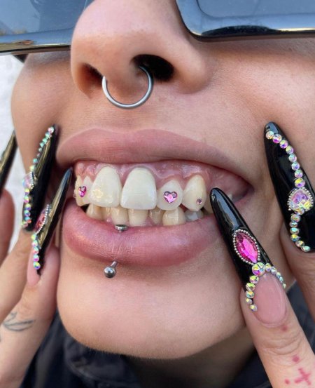 Скайсы на зубах