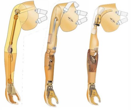 Бионический протез плеча