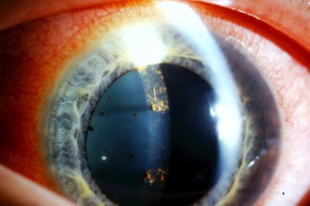 Фликтенулезный кератит