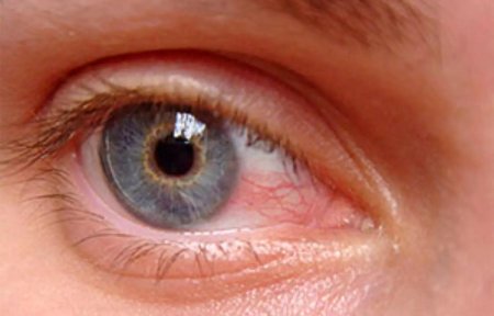 Ирит конъюнктивит увеит