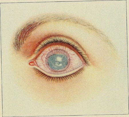 Паренхиматозный кератит