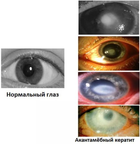 Акантабембный кератит