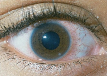 Кератит помутнение роговицы