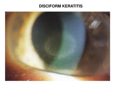 Герпетический кератит глаза