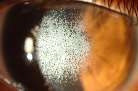 Карпообразная дистрофия роговицы