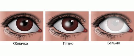 Помутнение роговой оболочки глаза