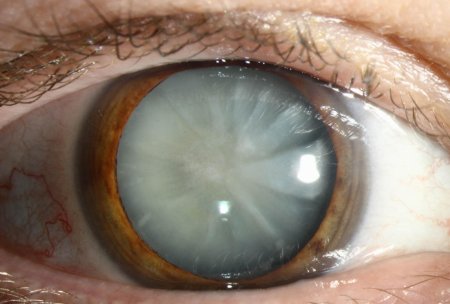 Миопизирующая катаракта