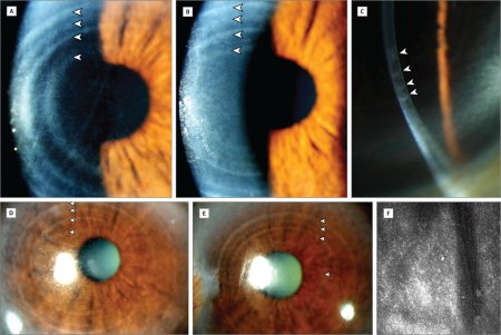 Решетчатая дегенерация роговицы