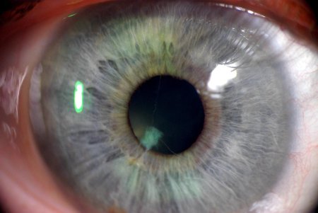 Персистирующая зрачковая мембрана