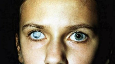 Гемералопия (куриная слепота)