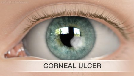 Кератит помутнение роговицы