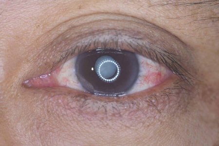 Пресенильная катаракта