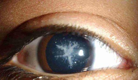 Тринитротолуоловая катаракта