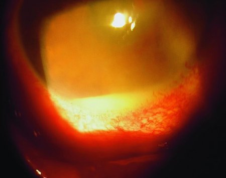 Увеит, Ирит, иридоциклит