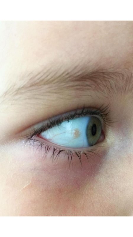 Пингвекула коньюктивита