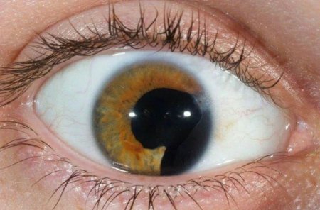 Колобома радужной оболочки глаза