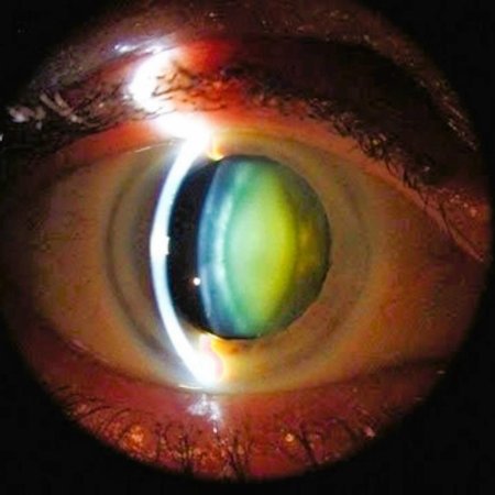 Катаракта биомикроскопия корковая