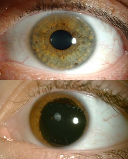 Гетерохромный иридоциклит Фукса