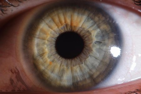 Воспаление роговицы глаза