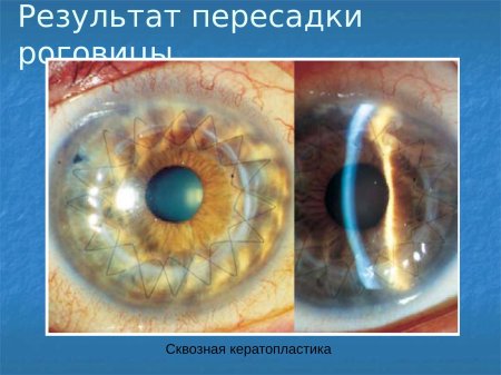 Послойная кератопластика