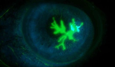 Кератит Флюоресцеиновая проба