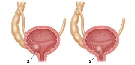 Уретероцеле цистоскопия