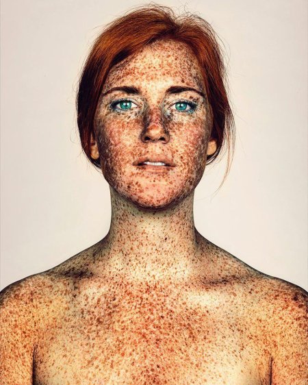 Пигментация ксеродерма